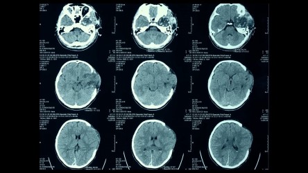 Malala talks about her recovery and forgiving those that harmed her. thumbn